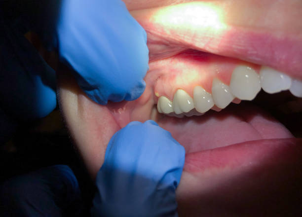 Best Emergency Dentist for Knocked-Out Tooth in Keokuk, IA